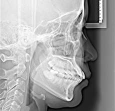 측면 두부규격 방사선 사진