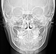 정면 두부규격 방사선 사진