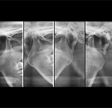 턱관절 방사선 사진