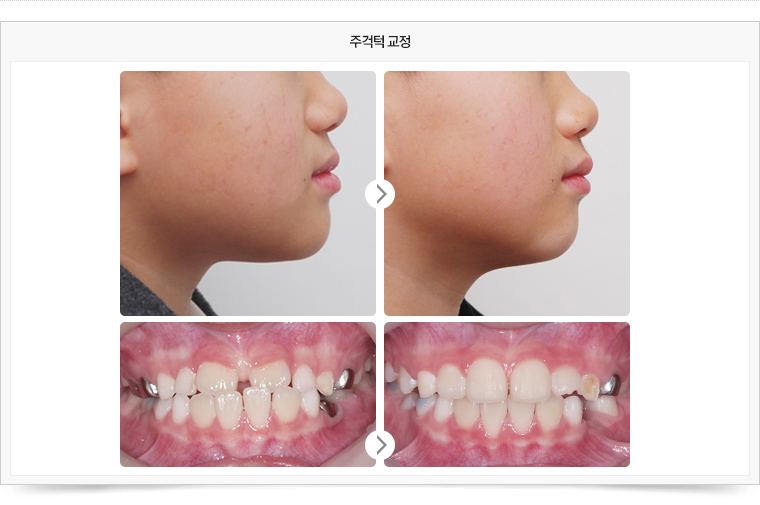 치료전후