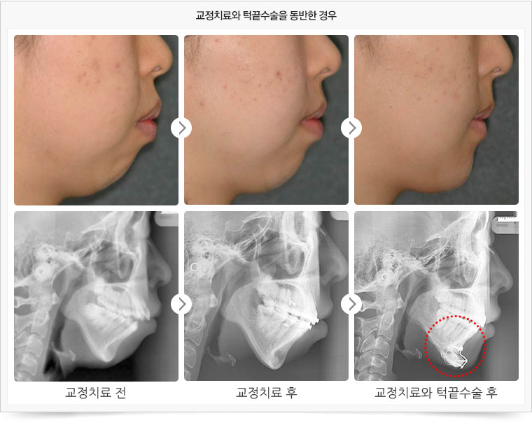 교정치료와 턱끝수수을 동반한 경우