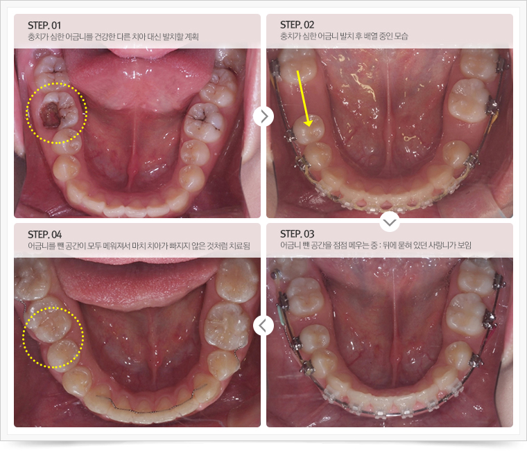 step1. 충치가 심한 어금니를 건강한 다른 치아 대신 발치할 계획
step2. 충치가 심한 어금니 발치 후 배열 중인 모습
step3. 어금니 뺀 공간을 점점 메우는 중 : 뒤에 묻혀 있던 사랑니가 보임
step4. 어금니를 뺀 공간이 모두 메워져서 마치 치아가 빠지지 않은 것처럼 치료됨