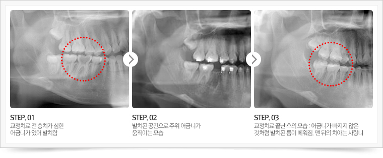 step1. 교정치료 전 충치가 심한 어금니가 있어 발치함
step2. 발치된 공간으로 주위 어금니가 움직이는 모습
step3. 교정치료 끝난 후의 모습 : 어금니가 빠지지 않은 것처럼 발치된 틈이 메워짐. 맨 뒤의 치아는 사랑니
